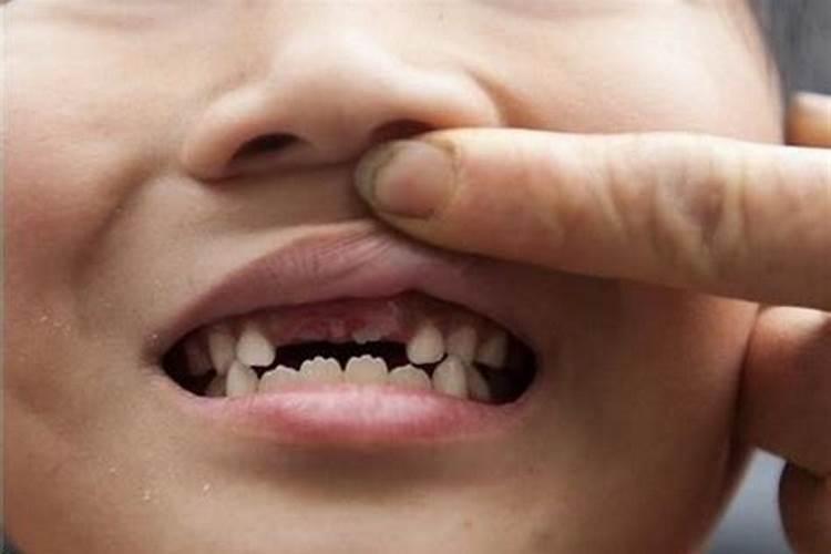 梦见孩子掉牙齿是什么征兆